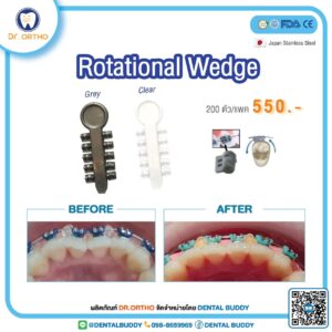 Rotational Wedge